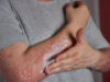 Eczedone: A Natural Solution for Lasting Eczema Relief Eczedone