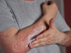 Eczedone: A Natural Solution for Lasting Eczema Relief Eczedone