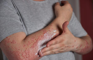 Eczedone: A Natural Solution for Lasting Eczema Relief Eczedone