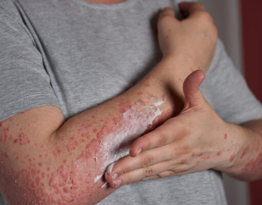 Eczedone: A Natural Solution for Lasting Eczema Relief Eczedone