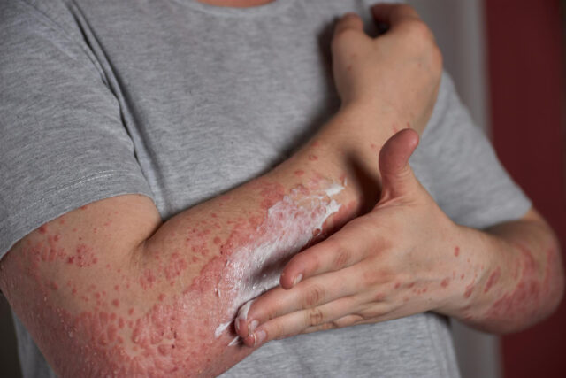 Eczedone: A Natural Solution for Lasting Eczema Relief Eczedone